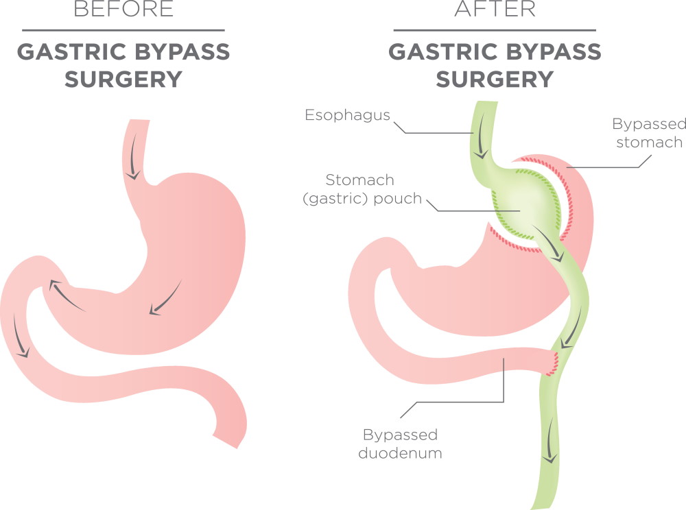 Dumping Syndrome Treatments Feel Better Today BMCC