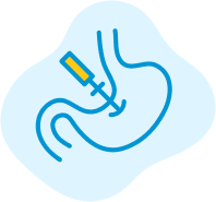 Illustration of a medical procedure related to bariatric surgery.